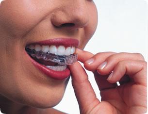Invisalign